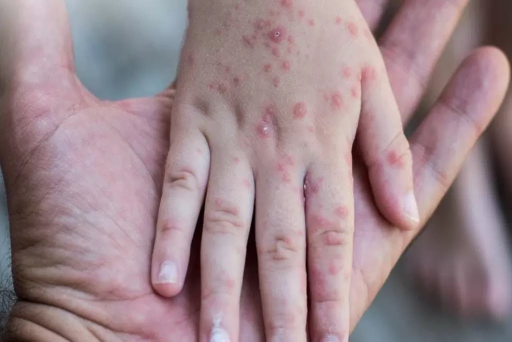 Kasus Campak Tembus 1.000 Suspek di Sumsel Awal 2026, Imunisasi Anak Digenjot