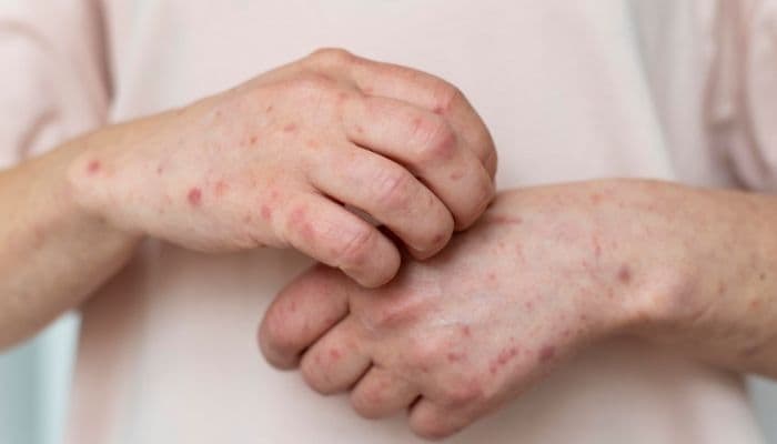 Kasus Campak Melonjak, Dinkes Palembang Gencarkan Vaksinasi Tambahan Jelang Lebaran