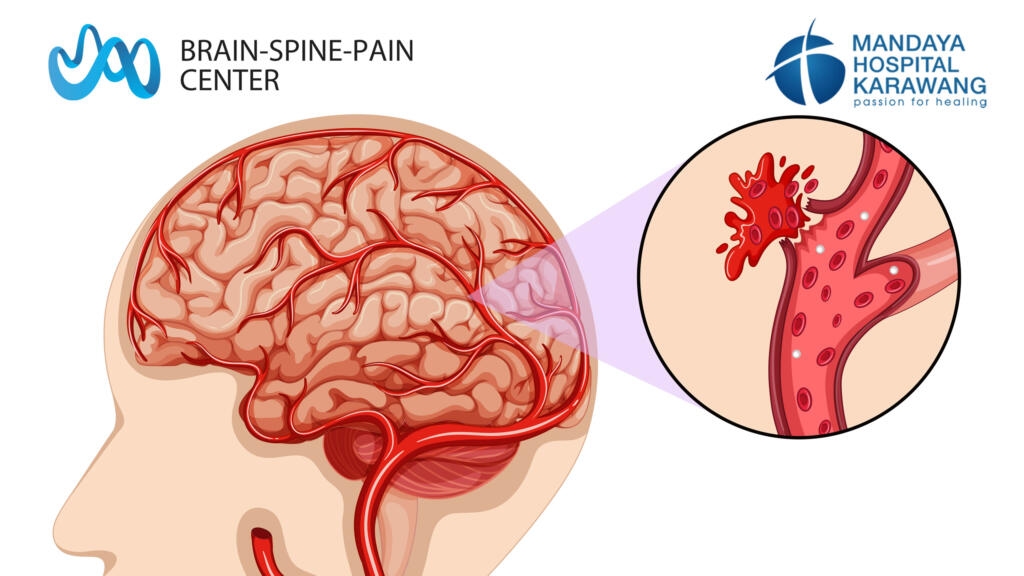 Jangan Dianggap Sepele, 7 Makanan Ini Sebaiknya Dibatasi untuk Menekan Risiko Stroke